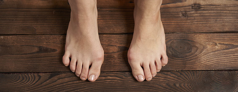 Joanete é a alteração óssea de pé mais comum entre os adultos