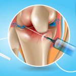 Infiltração: ortopedista desmistifica o procedimento e tira dúvidas comuns