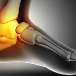 Prótese no tornozelo: Entenda como funciona