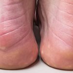 Esporão calcâneo causa dor intensa e deformidade no pé. Saiba como tratar