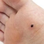 Verrugas plantares ou olho de peixe: O que são?