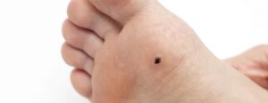 Verrugas plantares ou olho de peixe: O que são?