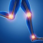 Osteocondrite: O que é essa dor que ocorre nas articulações?