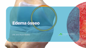edema osseo