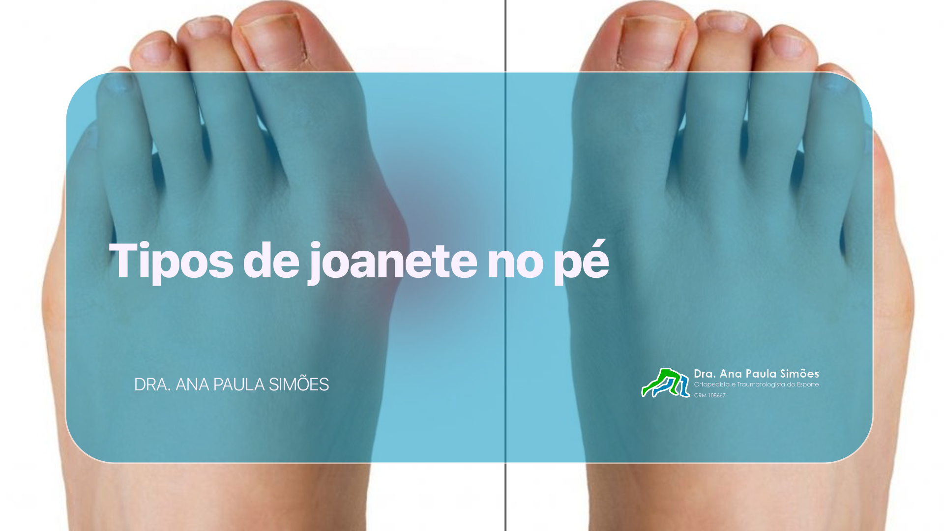 Tipos de no pé Tipos de no pé