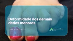 Deformidades dos demais dedos menores
