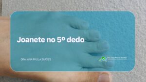 Joanete no 5º dedo